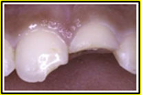 broken or cracked teeth