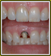 crown-bridge-veneer