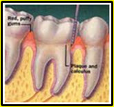 swollen-bleeding-gums