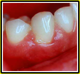 swollen-bleeding-gums