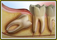 Wisdom Teeth Pain